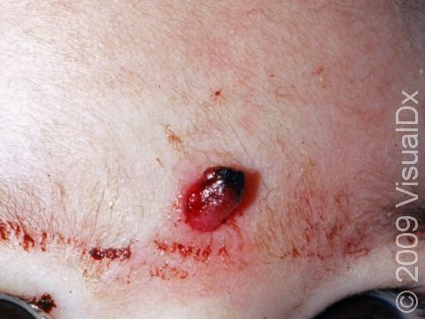 Pyogenic granulomas are very fragile and, when rubbed, can bleed easily.