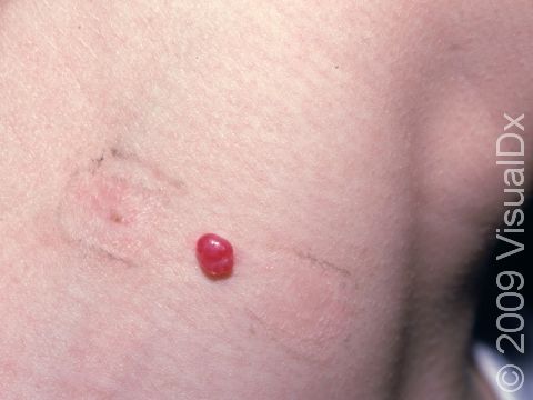 This pyogenic granuloma on the neck repeatedly bleeds from clothing friction.