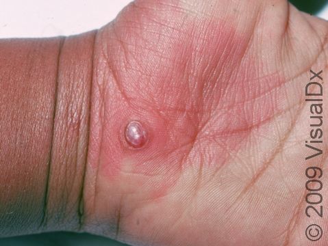 On thicker-skinned areas, such as the palm or sole, a lobular capillary hemangioma lesion may appear to have a 