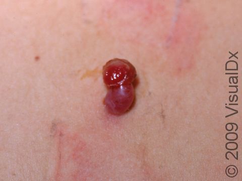 This pyogenic granuloma has a moist, easily bleeding surface.