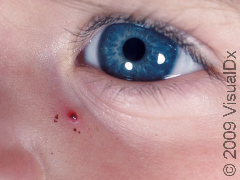 Pyogenic granulomas appear dark red and bleed easily when they are rubbed or scratched.