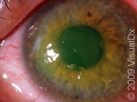 The irregularity of the cornea demonstrated here is seen both with recurrent corneal abrasion or a new corneal abrasion, with the history of the patient being the critical difference.