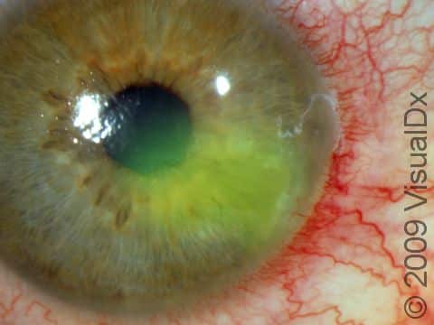 Using fluorescent dye helps show the extent of damage from this recurrent corneal abrasion.