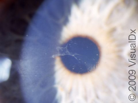 The irregularity of the layer of cells that covers the surface of the cornea (corneal epithelium), seen here, is a frequent finding in recurrent erosion.