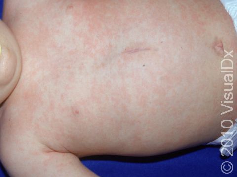 Pink, flat, or slightly raised bumps around 2 to 3 mm in diameter are typical of roseola (sixth disease).