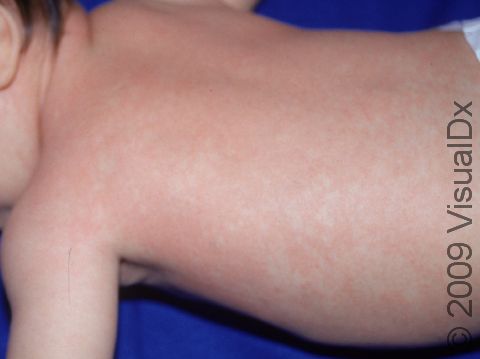 This image displays the pink, flat or slightly raised bumps 2-3 mm in diameter that are typical of roseola (sixth disease).