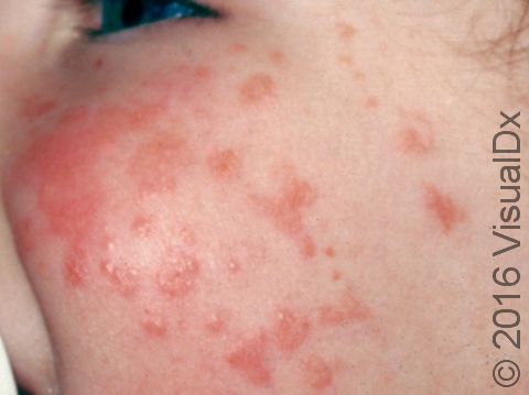 This image displays the bright pink rash typical of roseola (sixth disease).