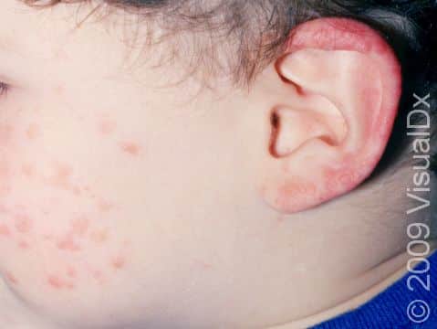 The rash of roseola (sixth disease) affects the face and ears of this infant.