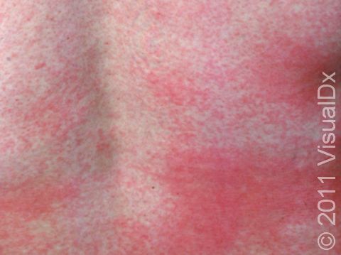 The back is covered in tiny red spots that merge into larger red patches at the waist of this person with rubella.