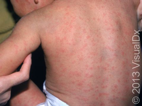 This image displays countless small, pink spots that have spread on the body typical of German measles.