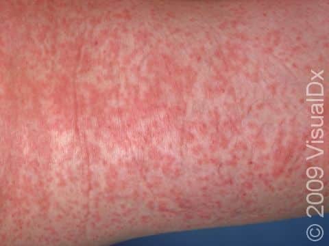 This image displays German measles with numerous pink-to-red bumps joining together.