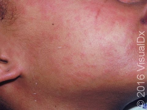 This image displays a rash on the face and red, peeling lips typical of measles in its early stage.