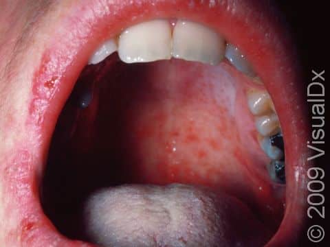 A red, swollen, sore throat is common with measles.