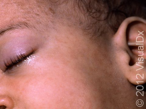 Runny, red eyes are typical of measles.
