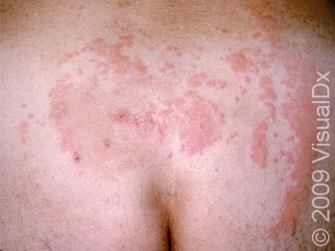This image displays the red slightly elevated lesions typical of sacral herpes simplex.