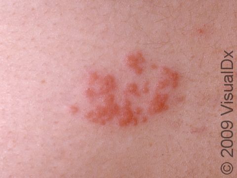 Though the lesions of herpes are typically described as fluid-filled, grouped, red elevations of the skin, this is not always the case. As displayed in this image, there may subtle or no fluid in herpes infections.