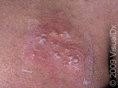 This image displays a grouping of pus-filled blisters located at the lower back and the buttocks, a common location for recurring attacks of herpes.