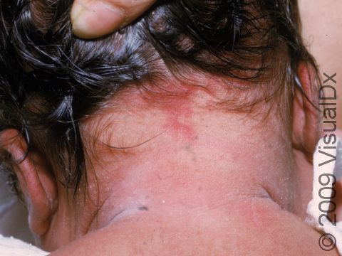 Salmon patches frequently occur at the back of the neck.