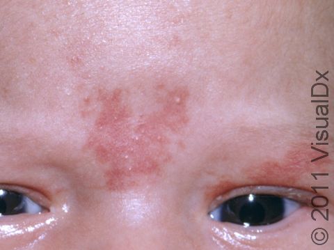 Salmon patches are typically light-pink patches at the mid-forehead.