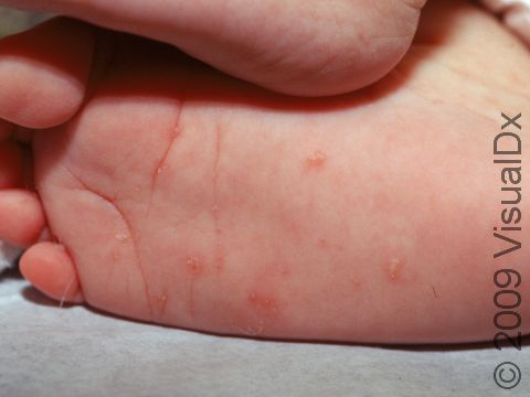 This image displays the tiny, linear, scaly trails of the scabies mite, called a burrow, on an infant's foot.