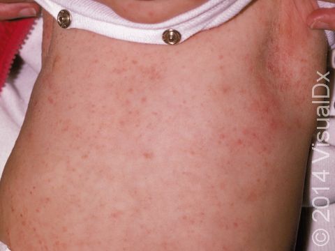 This image displays an infant with a widespread, bump-like allergic reaction to scabies, known as an id reaction.