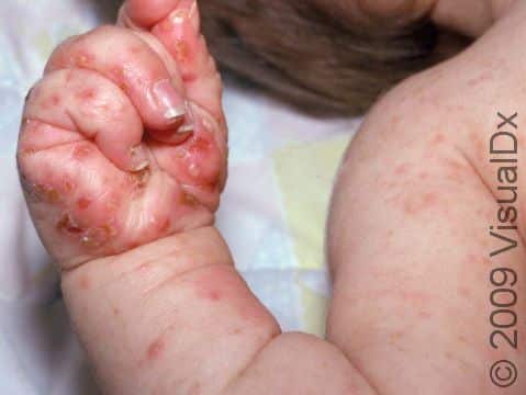 In infants, scabies can cause pus-filled lesions, as seen at the base of the thumb.