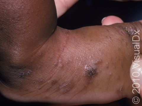This image displays a small, curving line of scale typical of a burrow; the other lesions show the spectrum of scabies with oozing and crusted skin lesions as well as bumps.