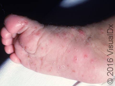 In infants with scabies, lesions of the soles and ankles are common.