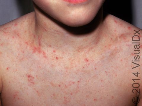 A child with scabies will often have a rash with small red bumps and scabs from scratching on the trunk and limbs.
