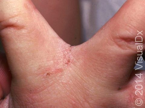 Look for tiny linear areas of redness and crusting between the fingers, representing the female mite's burrow.