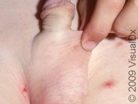 Itchy red bumps are common in the genital area in males with scabies.