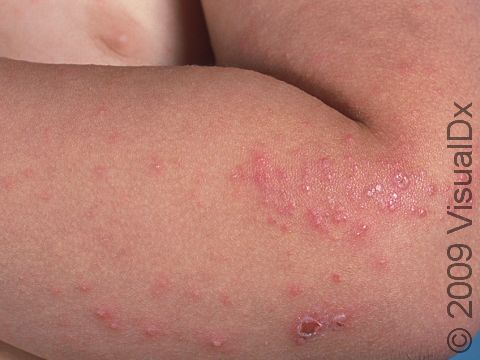 A child with scabies may have extensive involvement of all body areas. Scabies lesions are small red bumps that are often scratched due to their intense itch.