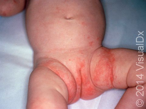 Scabies can cause a rash that looks similar to a diaper rash.