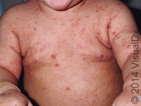On an infant, lesions from scabies can be widespread.