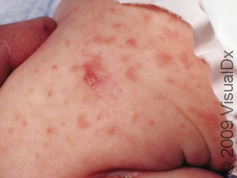 Scabies can have firm or nodular lesions as well as small, flat lesions, as seen on the limb of this infant.