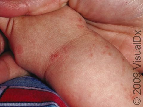 This image displays pink, raised lesions at the wrists typical of scabies on an infant.