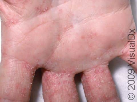 This image displays red, crusted, scaling patches on a patient's hand, typical of scabies.