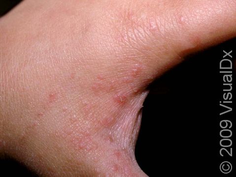 This image displays a typical example of scabies lesions.