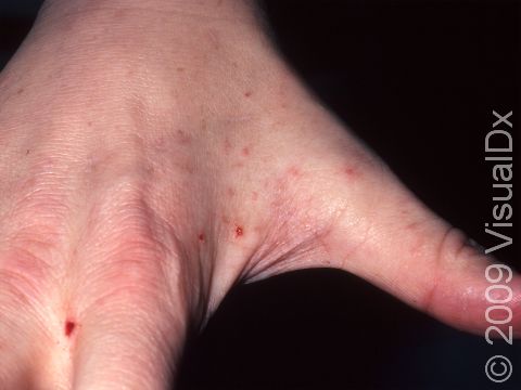 As displayed in this image, bleeding can accompany scabies due to scratching the affected area.