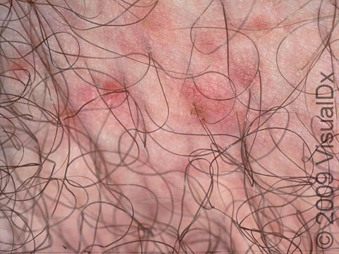 This image of the pubic area shows the itchy red bumps of scabies that may be all over the body (widespread).