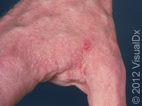 This image displays a very fine line with scale in the webbed area of the hand due to burrowing of the scabies mite.
