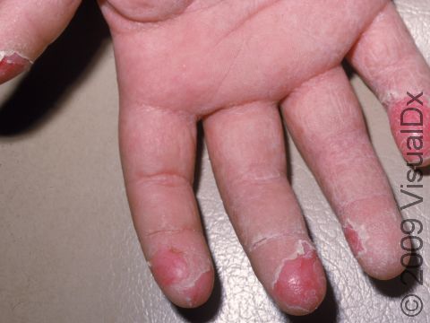 During the resolution phase of scarlet fever, the widespread rash begins to peel.