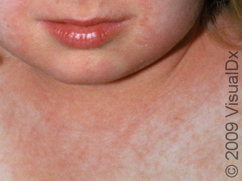 This image displays the red rash typical of scarlet fever.