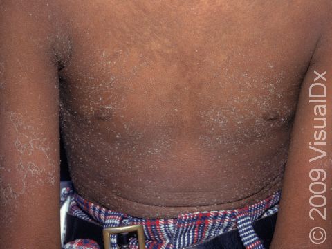 This image displays the previously pink, sandpaper-like rash of scarlet fever starting to peel and improve.