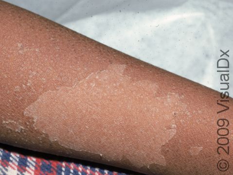 This image displays the tiny pink bumps of scarlet fever beginning to peel as the patient improves.