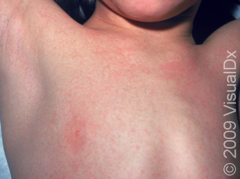Numerous tiny red bumps of scarlet fever are sometimes more easily felt than seen (giving the typical sandpaper-like feel).