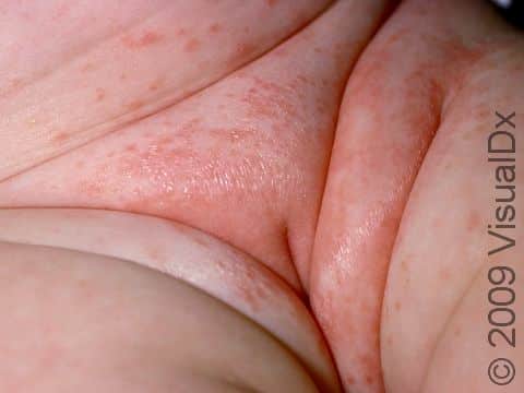 This image displays red, bumpy patches of seborrheic dermatitis on the diaper area of an infant.