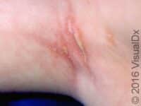 Seborrheic Dermatitis (Pediatric)