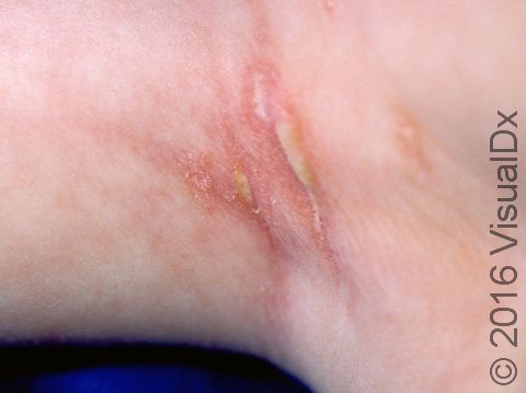 This image displays red, scaling, slightly elevated lesions with a yellowish-white, greasy appearance typical of seborrheic dermatitis in infants.