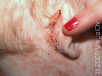 Seborrheic Dermatitis (Pediatric)